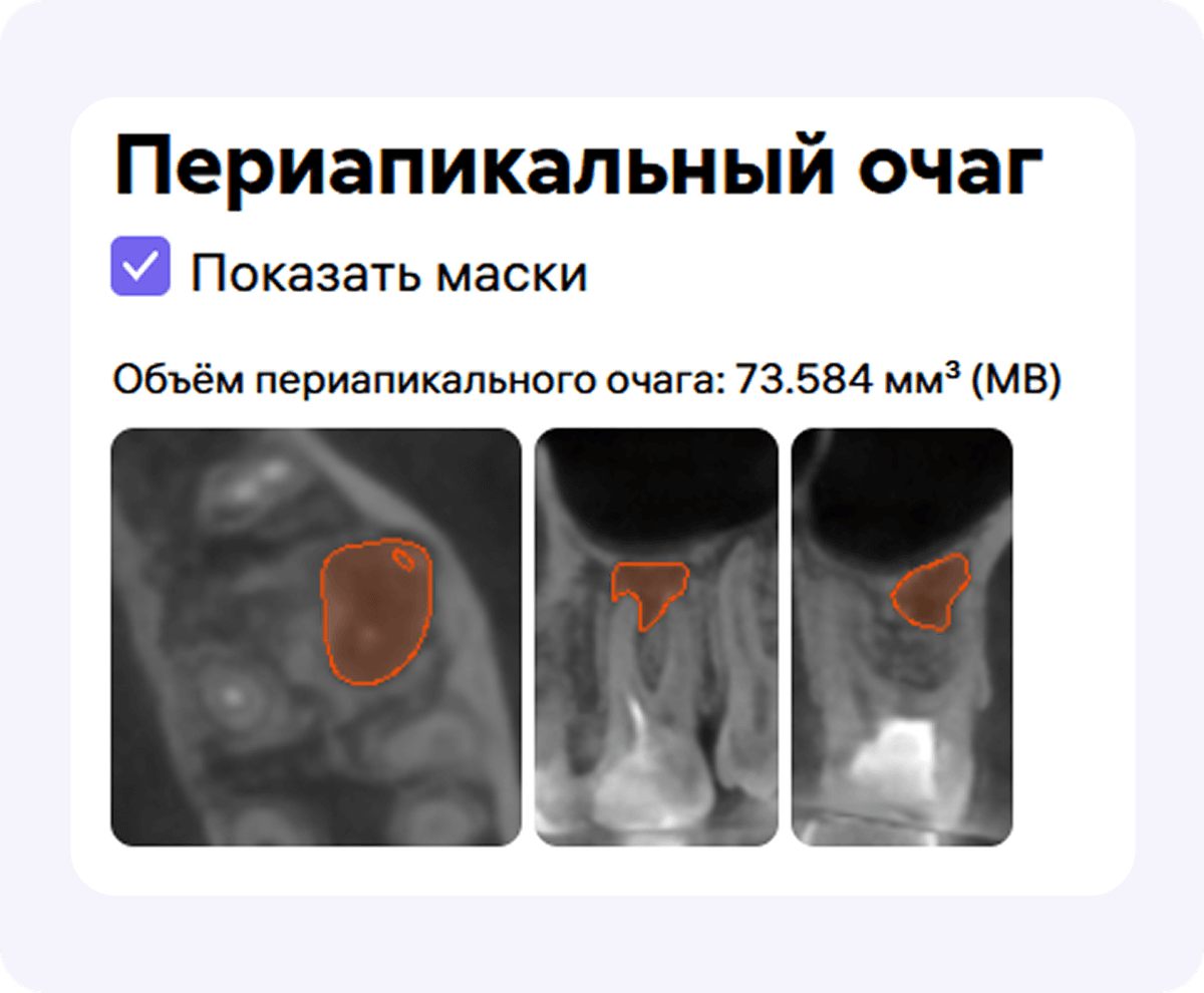 [object Object], с автоматическим измерением объёма периапикального очага.
