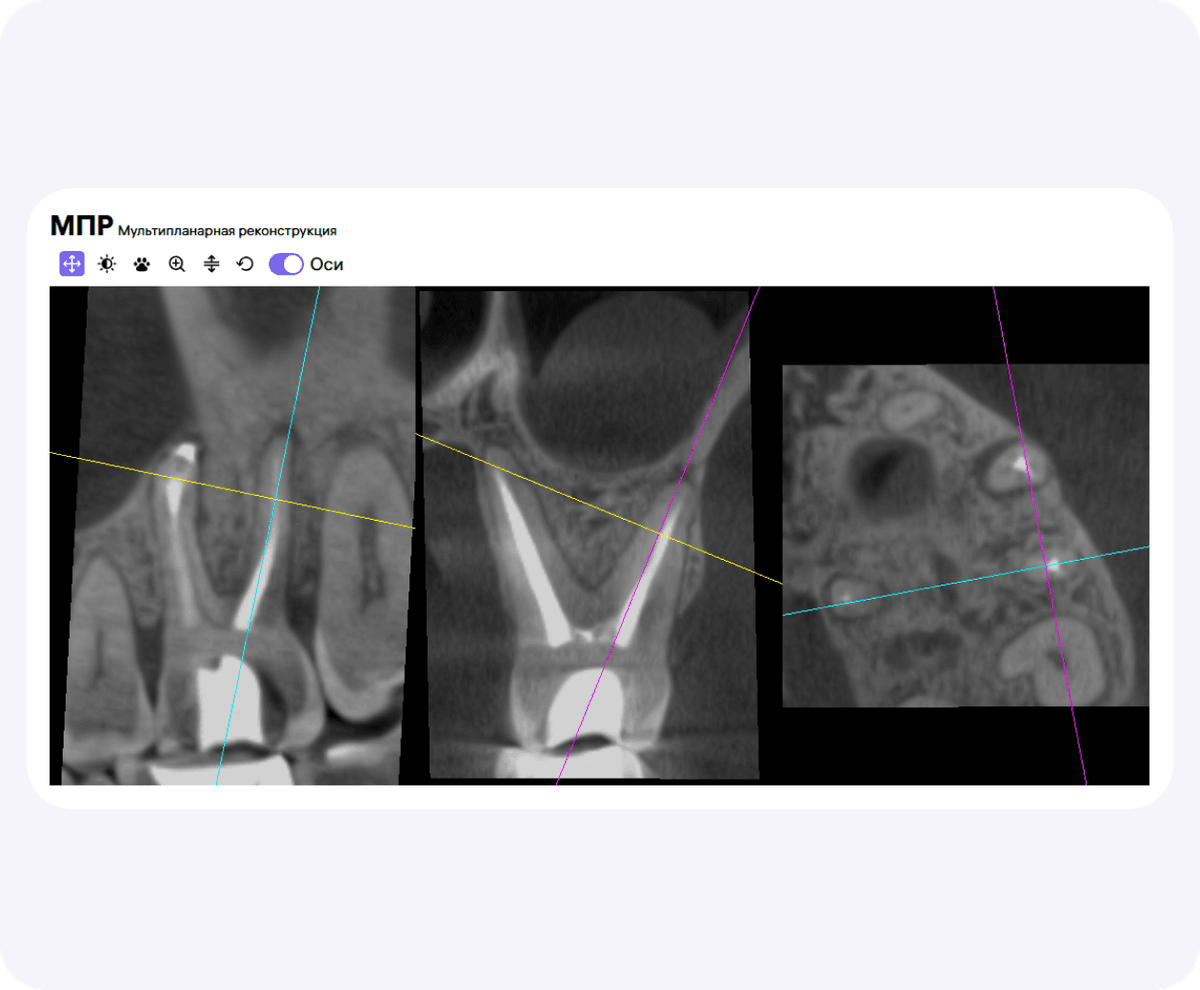 [object Object], от Diagnocat встроена в рентгенологический отчет и позволяет проводить анализ выбранной области интереса.