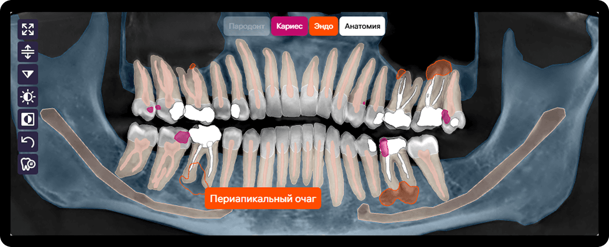 Отображение масок патологий на всех видах снимков для быстрой навигации.