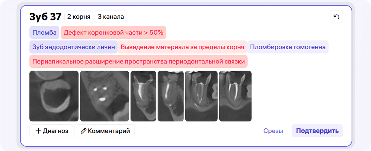 [object Object], автоматически определяет объём разрушения зуба, позволяя точно установить показания к ортопедическому лечению и упрощая коммуникацию с пациентом.