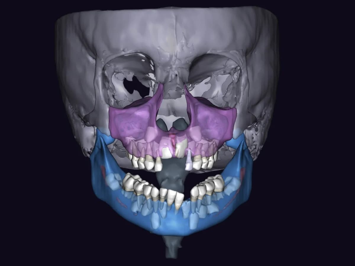 Реконструкция в 3D отчёте Diagnocat после удаления зубов 5.1,6.1.