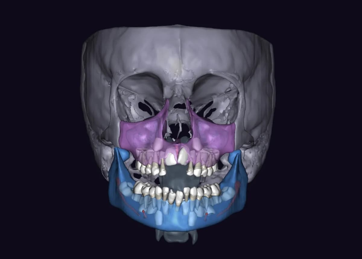Реконструкция в 3D отчёте Diagnocat через 3 месяца после начала лечения