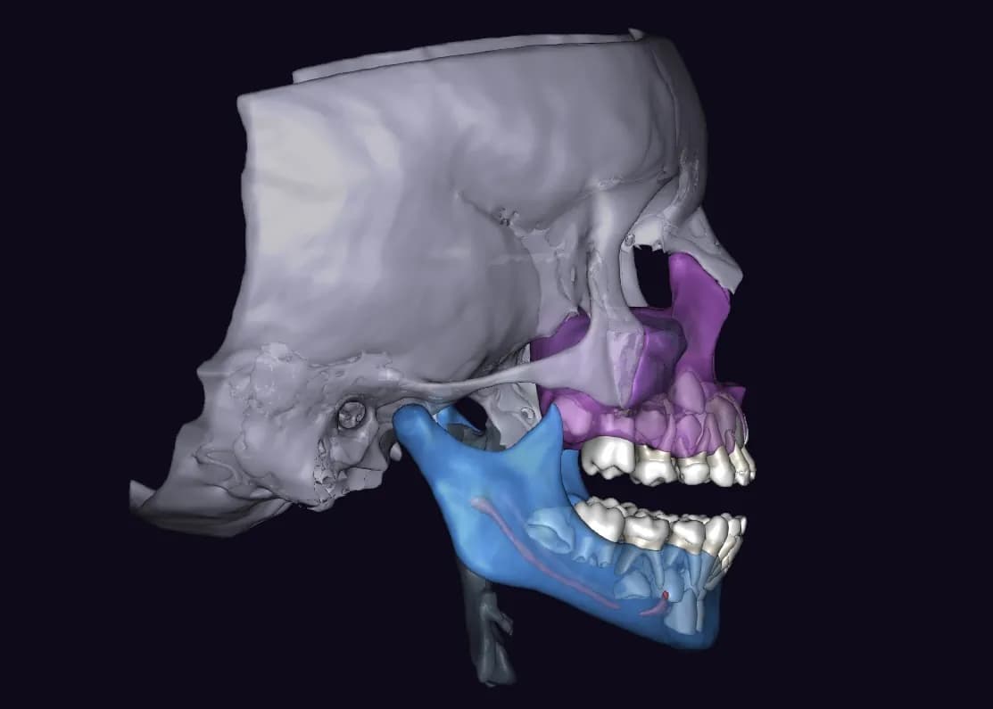 Реконструкция в 3D отчёте Diagnocat через 3 месяца после начала лечения