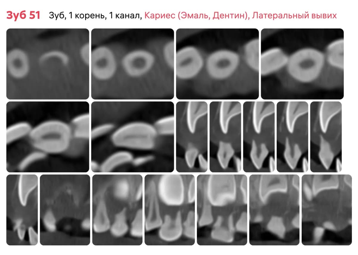 Срез Diagnocat 5.1 зуба до начала лечения