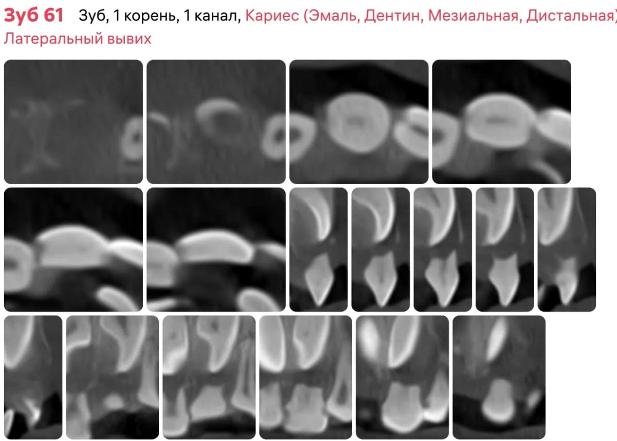 Срез Diagnocat 6.1 зуба до начала лечения