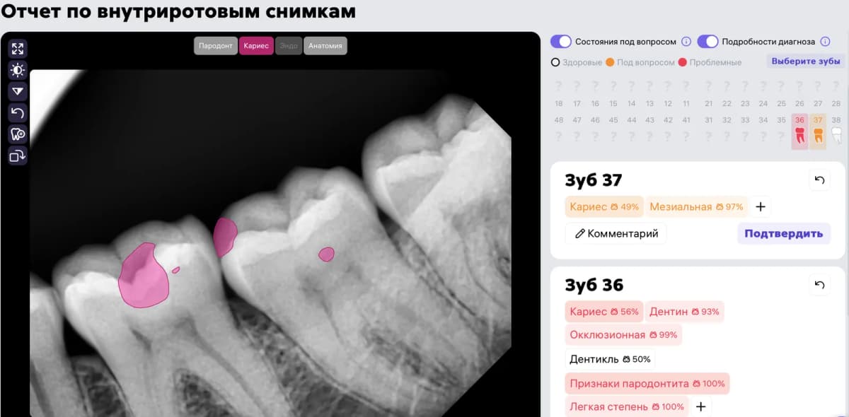 Прицельная внутриротовая рентгенограмма с масками Diagnocat