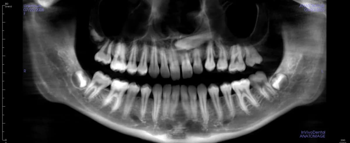 Вытяжение ретенированного клыка 2.3 с планированием в Diagnocat