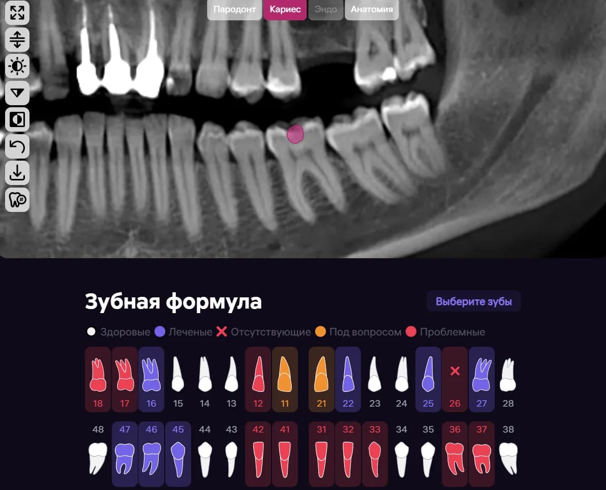 Диагностика и лечение кариеса зубов 3.6 и 3.7