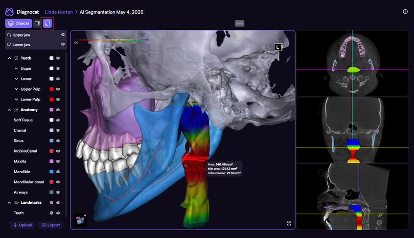Анализ дыхательных путей в 3D-отчете Diagnocat
